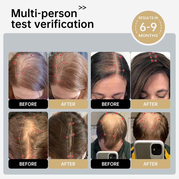 Freyara - Red Light & Blue Light Therapy Cap 258 LEDs Freyara - Red Light & Blue Light Therapy Cap 258 LEDs