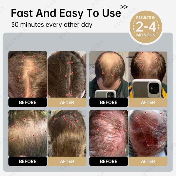 Freyara - LLLT Laser Red Light Therapy Cap - 264 LLLT